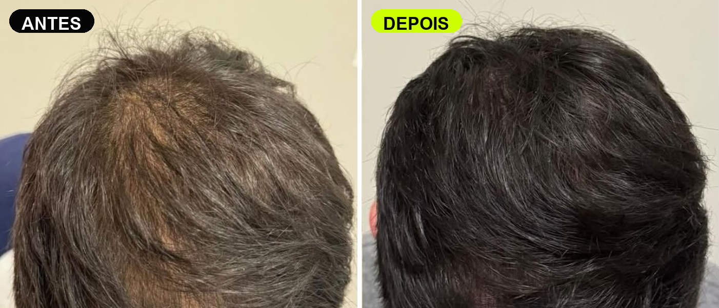 Antes e depois de tratamento capilar UP Hair