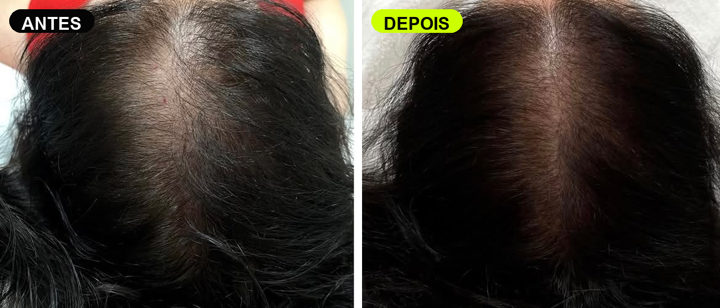 Antes e depois de paciente UP Hair