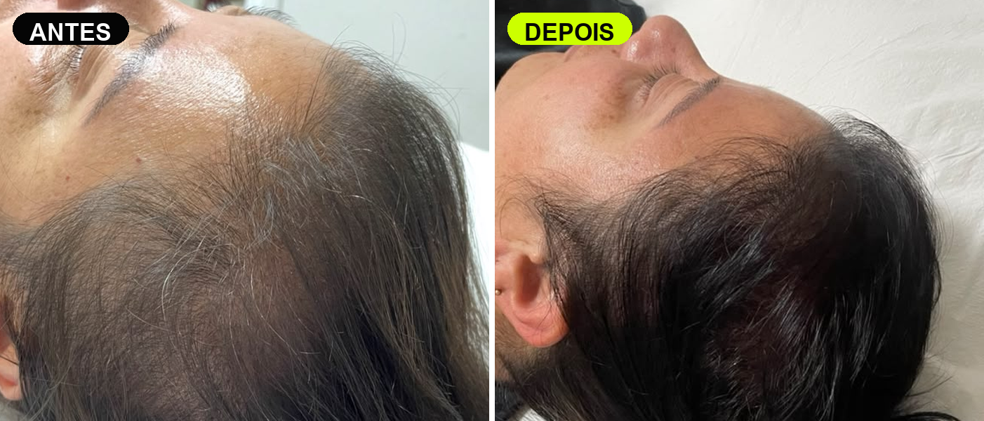 Evolução de tratamento capilar UP Hair